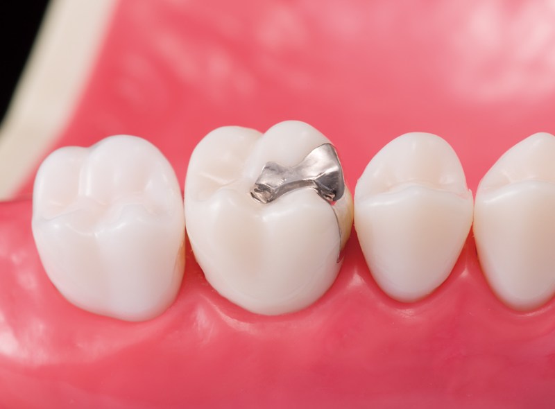 審美歯科（セラミック）のご相談は滋賀県草津市の「KANAYAMA DENTAL