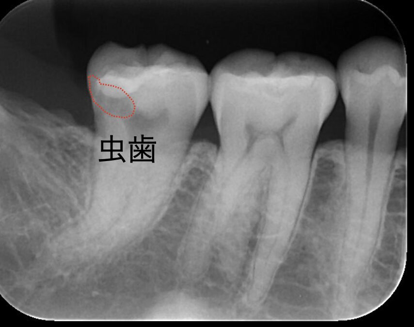 虫歯が大きく根管治療を行いセラミッククラウンで治療した症例(2