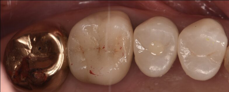 インプラント治療のご相談は滋賀県草津市の「KANAYAMA DENTAL CLINIC」へ